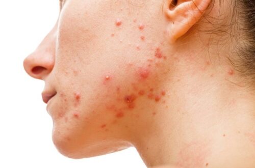 Skincare Kulit Berjerawat