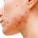 Skincare Kulit Berjerawat