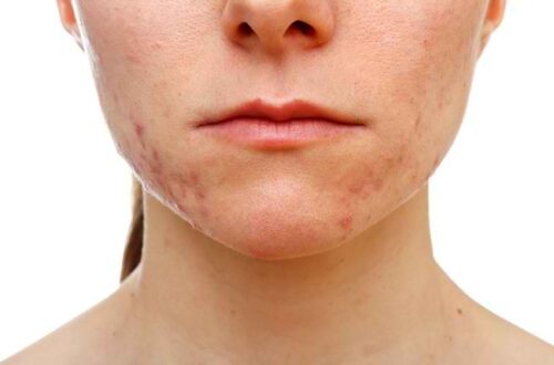 breakout skincare