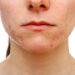 breakout skincare