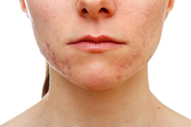 breakout skincare